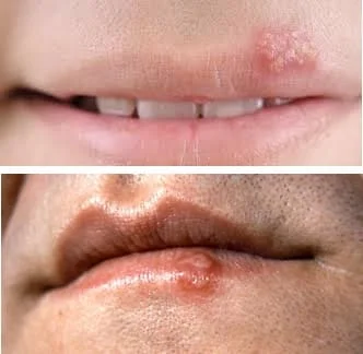 Herpes-viruss-1.webp