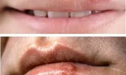 Herpes-viruss-1.webp