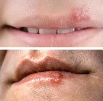 Herpes vīruss