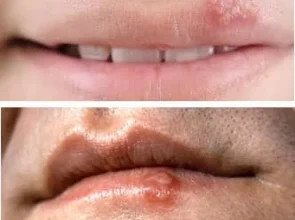 Herpes vīruss, neredzamais pavadonis vīrusu pasaulē
