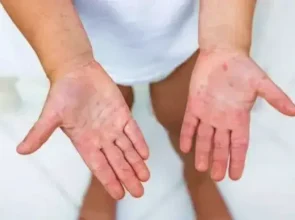 Koksaki vīruss, kā izpaužas slimības norise un sekas